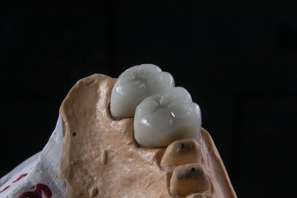 Dentist reviewing a model showing a dental bridge and implant beside a patient in a clinical room.
