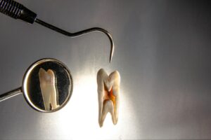 Dentist examining a patient’s cracked molar with a dental mirror and overhead light.