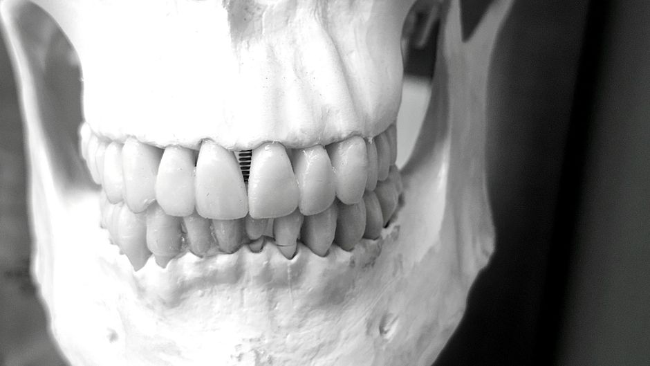 A dentist examines an implant-supported crown while a patient holds a dental cleaning brush.